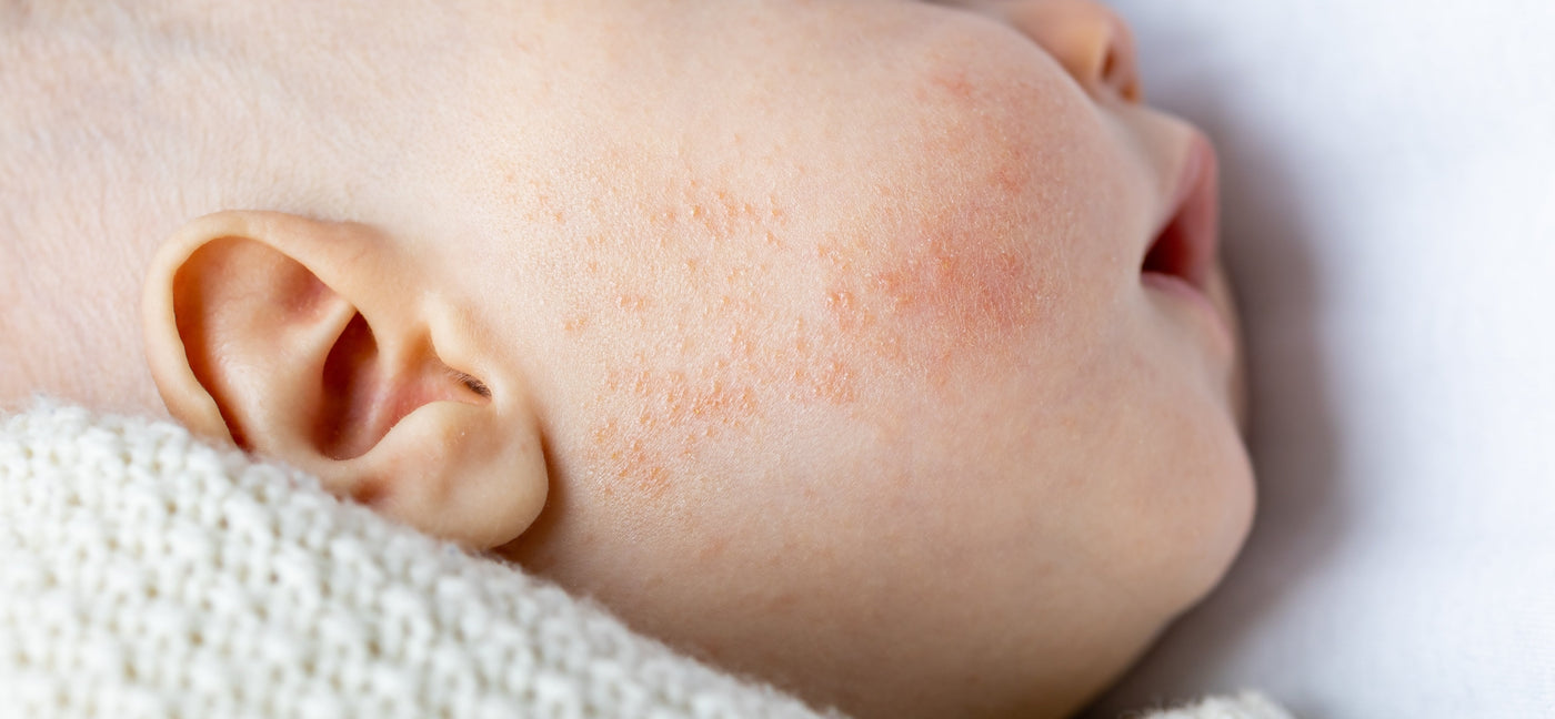 Eczeem, Acne, Pukkeltjes of Puistjes bij je Baby, wat nu?